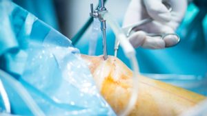 כירורגיה אורטופדית של הברך