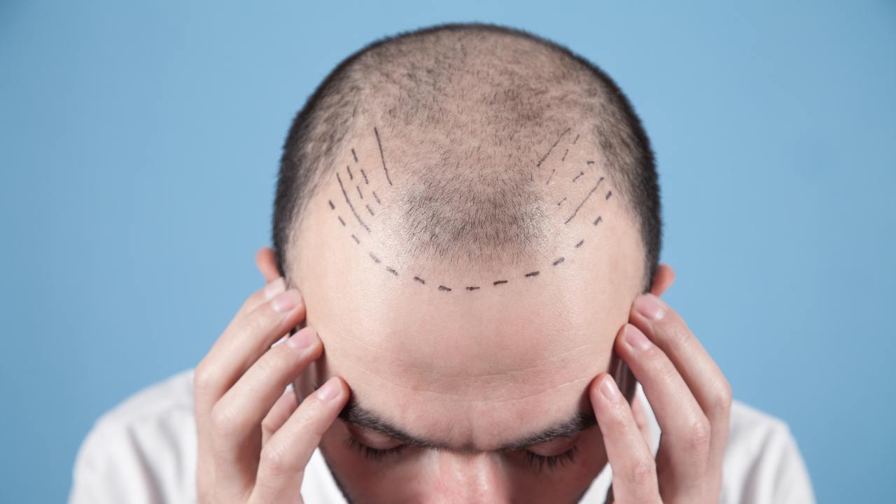 השתלת שיער - הטיפול האסטטי החדש סוחף גברים בשנים האחרונות